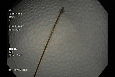 Tưởng đau dạ dày hoá tăm nhọn “ngự” lâu năm không biết