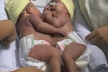 Tách cặp song sinh dính liền nhau vùng bụng