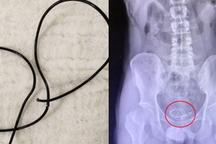 Hy hữu: Chàng trai trẻ tự nhét đoạn dây tai nghe dài 20cm vào niệu đạo