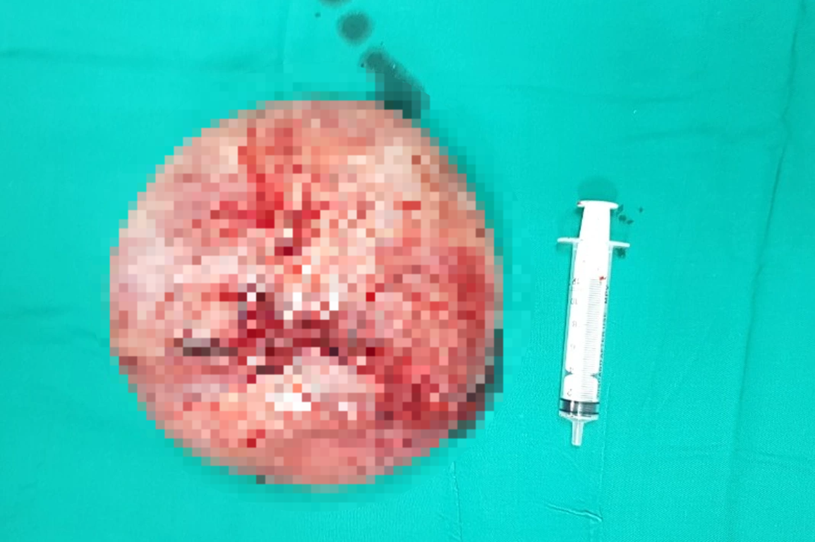 Ngại đi khám vì Covid-19, cụ ông để khối u phát triển to như quả cam - 1 Ngại đi khám vì Covid-19, cụ ông để khối u phát triển to như quả cam - 1