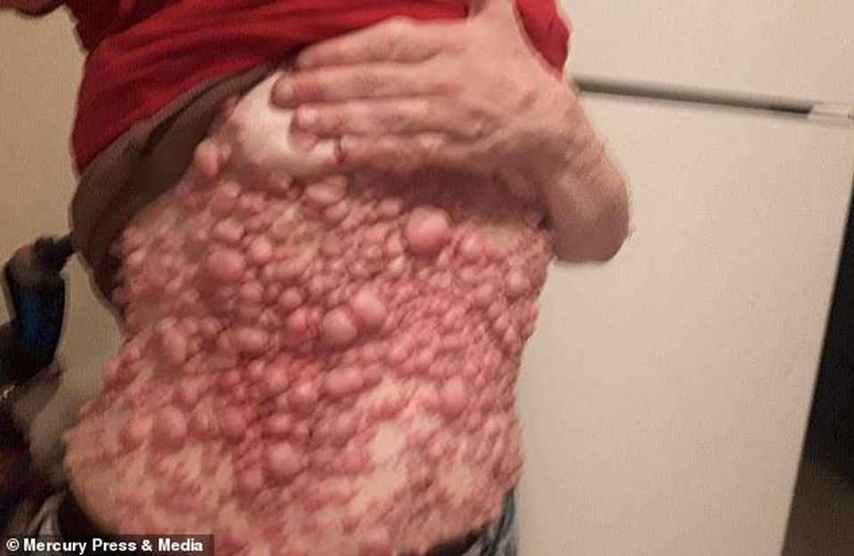 Người phụ nữ công khai cơ thể bị hàng ngàn khối u bao phủ - 4