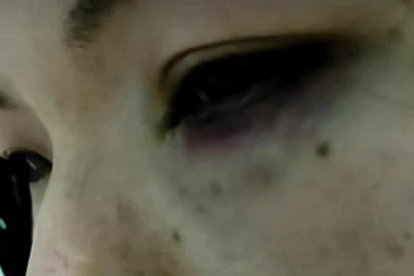 Một phụ nữ nghi bị chồng và mẹ chồng đánh nhập viện