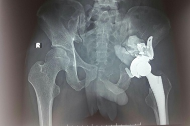 Ngỡ đau khớp hoá khối u hiếm gặp