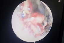 Gắp 4 con ve chó trong tai bé gái 10 tuổi