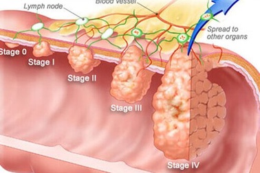 Phát hiện sớm ung thư đại trực tràng ngay từ "trong trứng"