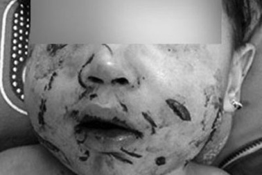 Hai trẻ bị chó cắn rách nát vùng mặt