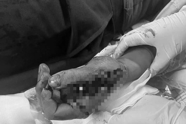 Pháo phát nổ trên tay, chàng trai trẻ chấn thương nghiêm trọng