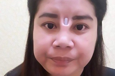 Sốc với khuôn mặt phẫu thuật thẩm mỹ hỏng, lòi cả silicone ra ngoài