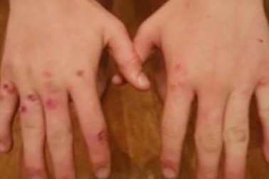 Thiếu niên nhiễm vi rút đậu mùa cực hiếm từ thế kỷ 18