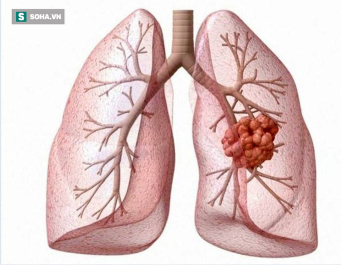 Không hút thuốc vẫn có thể mắc ung thư phổi: Chuyên gia chỉ cách tốt nhất phát hiện bệnh sớm - Ảnh 2.