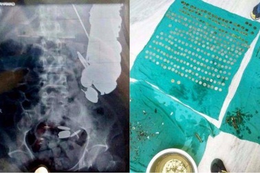 Kinh dị bệnh nhân nuốt 7kg tiền xu, đinh ốc vào bụng vì bị trầm cảm
