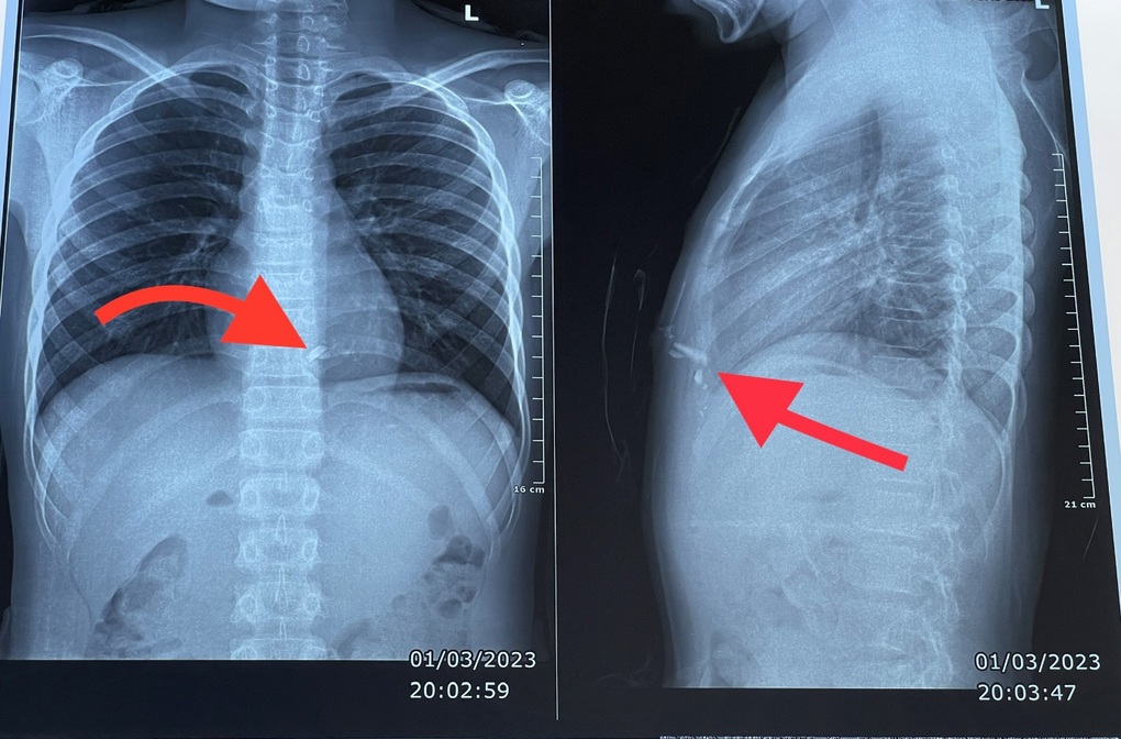 Pháo tự chế phát nổ, dị vật kim loại xuyên vào lồng ngực cậu bé 14 tuổi - 1 Pháo tự chế phát nổ, dị vật kim loại xuyên vào lồng ngực cậu bé 14 tuổi - 1
