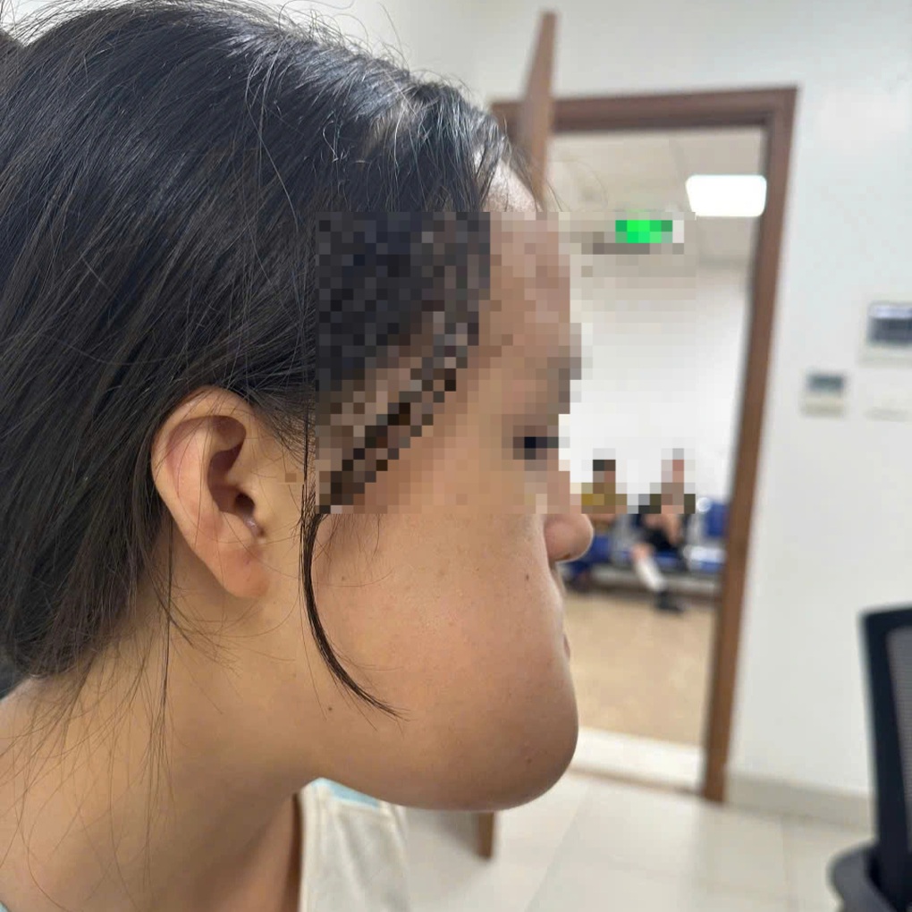 بعد 9 ساعات من الجراحة، أنقذ الأطباء امرأة شابة من ورم عملاق في وجهها - 1 Sau 9 giờ phẫu thuật, bác sĩ giải cứu thiếu nữ khỏi khối u khổng lồ ở mặt - 1