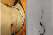 Phẫu thuật lấy lưỡi câu cắm sâu vào chân cậu bé 3 tuổi