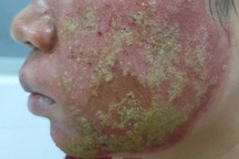 Ô nhiễm không khí “sát thủ” gây viêm da cơ địa