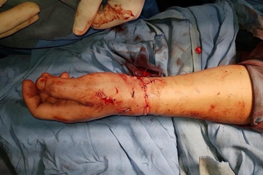 5 tiếng nối thành công bàn tay bị đứt lìa