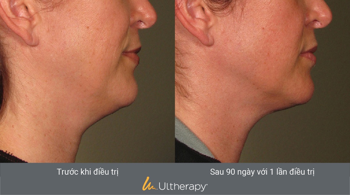 Đẩy lùi lão hóa sớm với công nghệ nâng cơ, căng da Ultherapy - 3 Đẩy lùi lão hóa sớm với công nghệ nâng cơ, căng da Ultherapy - 3