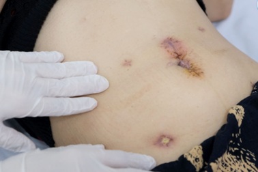 “Trốn” điều trị về uống thuốc nam, nữ bệnh nhân ung thư suýt mất mạng