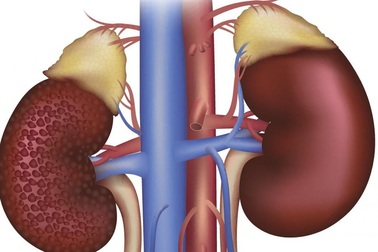 Bệnh thận - biến chứng đáng sợ của đái tháo đường