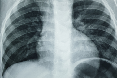 Cậu bé 2 tuổi bị dị vật mảnh kim loại “ăn” vào thực quản, ho cả tháng mới được phát hiện