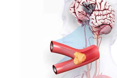 Cảnh báo đột quỵ sớm ở người 40-45 tuổi