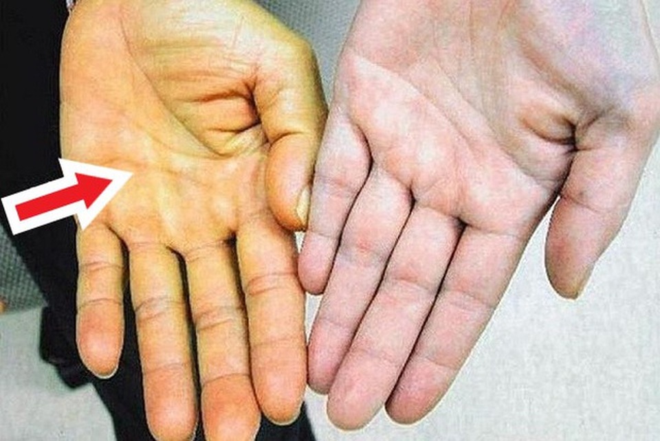 Chế độ ăn uống phản khoa học gây ung thư gan như thế nào? - 4 Chế độ ăn uống phản khoa học gây ung thư gan như thế nào? - 4
