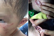 Phụ huynh tố cô giáo đánh bé gái 30 tháng tuổi bị thương