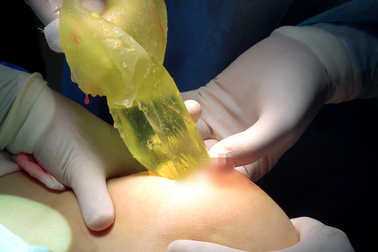 Vỡ túi ngực, silicon tràn ra như… “đầm lầy”