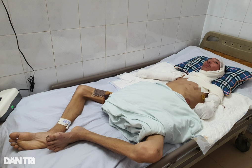 Người đàn ông khóc nghẹn khi nhìn vào 2 tay bị cắt cụt vì bỏng điện cao thế - 1 Người đàn ông khóc nghẹn khi nhìn vào 2 tay bị cắt cụt vì bỏng điện cao thế - 1
