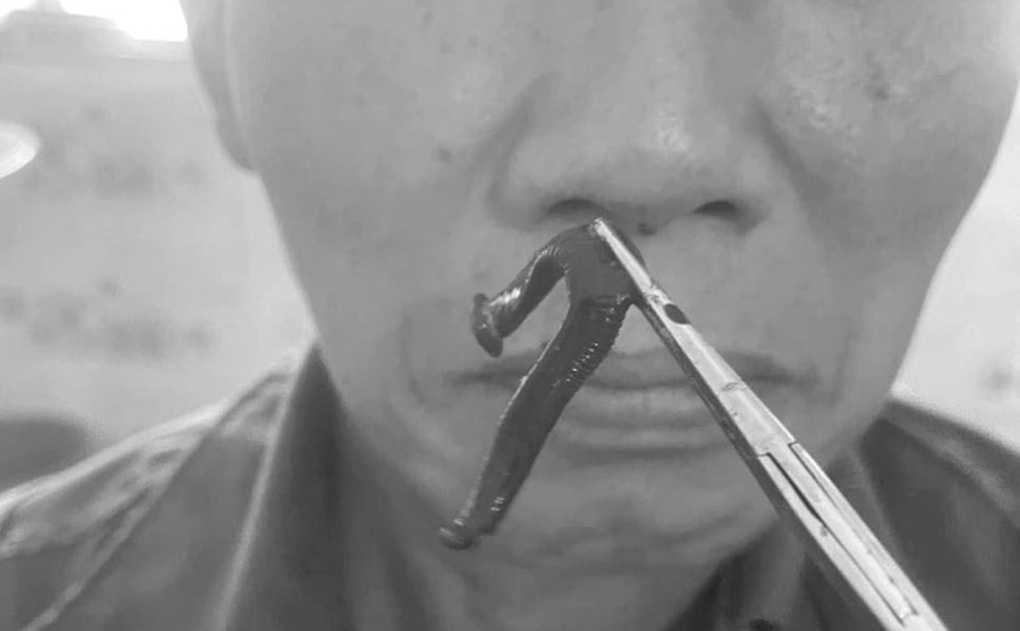 Ngạt mũi, chảy máu mũi suốt 2 tuần vì dị vật sống làm tổ trong mũi - 1 Ngạt mũi, chảy máu mũi suốt 2 tuần vì dị vật sống làm tổ trong mũi - 1