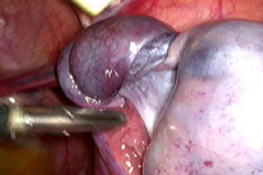 Cảnh giác những cơn đau bụng âm ỉ ở bé gái