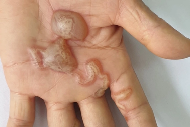 Bị ngứa 10 năm mới biết giun từ chó mèo "đào hầm" trong da