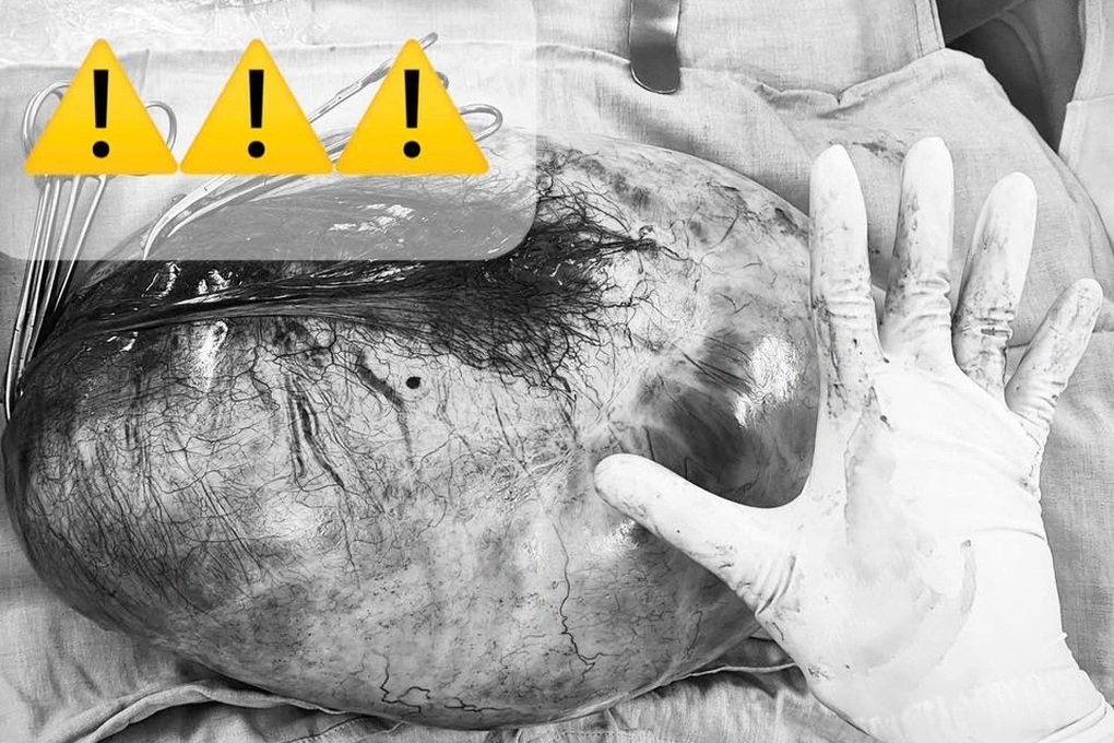 ورم يزن حتى 8 كجم في مبيض فتاة تبلغ من العمر 13 عامًا - 2 Khối u nặng tới 8kg trong buồng trứng bé gái 13 tuổi - 2