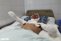 Người đàn ông khóc nghẹn khi nhìn vào 2 tay bị cắt cụt vì bỏng điện cao thế