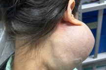 Bệnh nhân mang khối u khổng lồ trên mặt vì không làm điều này suốt 14 năm