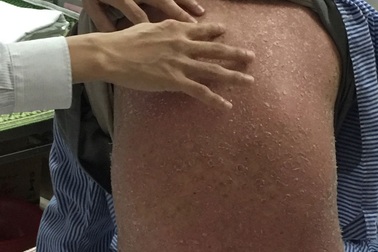 5 thách thức hàng triệu người mắc vảy nến đang phải đối mặt