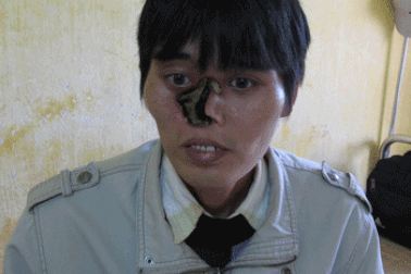 Vết loét ăn mòn toàn bộ thóp mũi