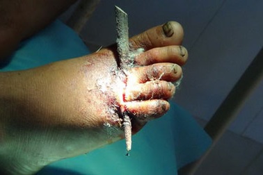 Cấp cứu ngư dân bị cá đâm ở Trường Sa