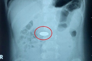 2 đồng xu máy chơi game chui tọt vào đường tiêu hóa bệnh nhi