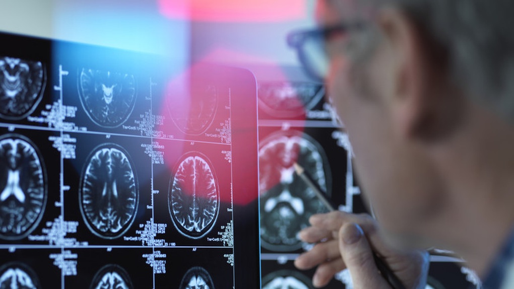 Nga thành công thử nghiệm sơ bộ chiến lược mới điều trị bệnh Alzheimer - 1 Nga thành công thử nghiệm sơ bộ chiến lược mới điều trị bệnh Alzheimer - 1