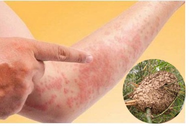 Ăn trứng kiến, thanh niên 21 tuổi nổi mẩn đỏ toàn thân, mắt sưng nề