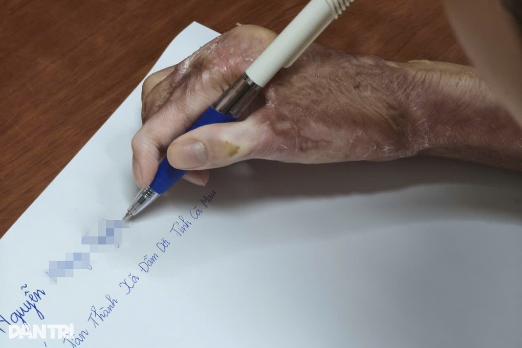 Thiếu nữ 17 tuổi bị bạn đốt keo nến làm cháy khắp người, phải mổ 15 lần - 3 Thiếu nữ 17 tuổi bị bạn đốt keo nến làm cháy khắp người, phải mổ 15 lần - 3