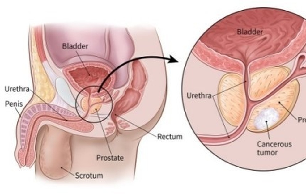 Dấu hiệu bí đái ở nam giới có thể cảnh báo ung thư tiền liệt tuyến - 1 Dấu hiệu bí đái ở nam giới có thể cảnh báo ung thư tiền liệt tuyến - 1