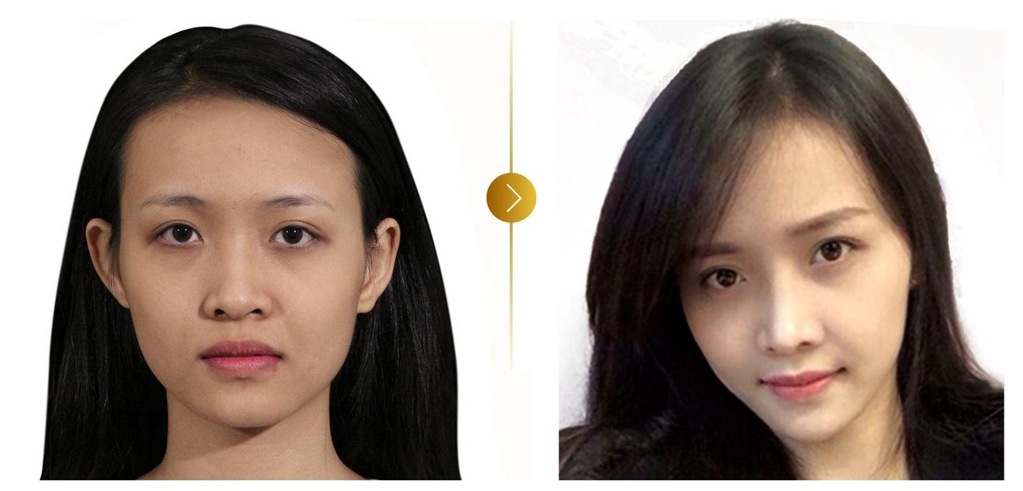 Người trẻ thường tự ti về khuyết điểm của mũi - 2 Người trẻ thường tự ti về khuyết điểm của mũi - 2