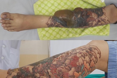 Bỏng nặng độ 3 sau khi xóa xăm bằng laser