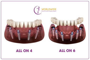 Người mất răng toàn hàm, phải làm sao?