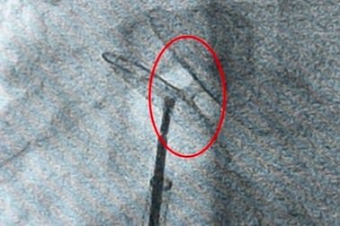 Một dị tật ở tim 25% dân số mắc phải có thể gây đột quỵ?