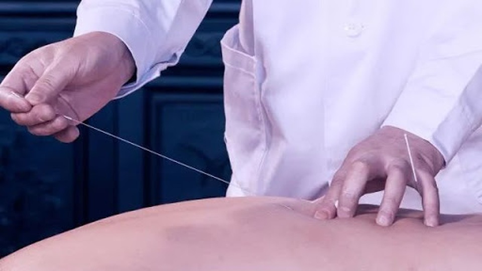 Những kỹ thuật châm cứu vang danh thế giới của Thần kim - 2 Những kỹ thuật châm cứu vang danh thế giới của Thần kim - 2