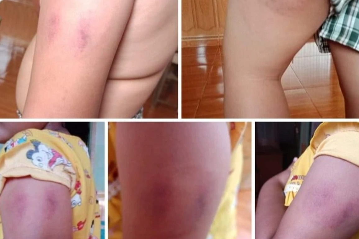 Bé gái lớp 1 bị cô giáo đánh vì… không làm xong bài kiểm tra - 1 Bé gái lớp 1 bị cô giáo đánh vì… không làm xong bài kiểm tra - 1