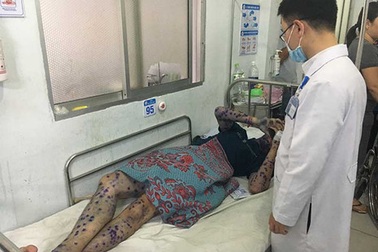 Phát hiện ổ dịch thủy đậu trong khu chế xuất